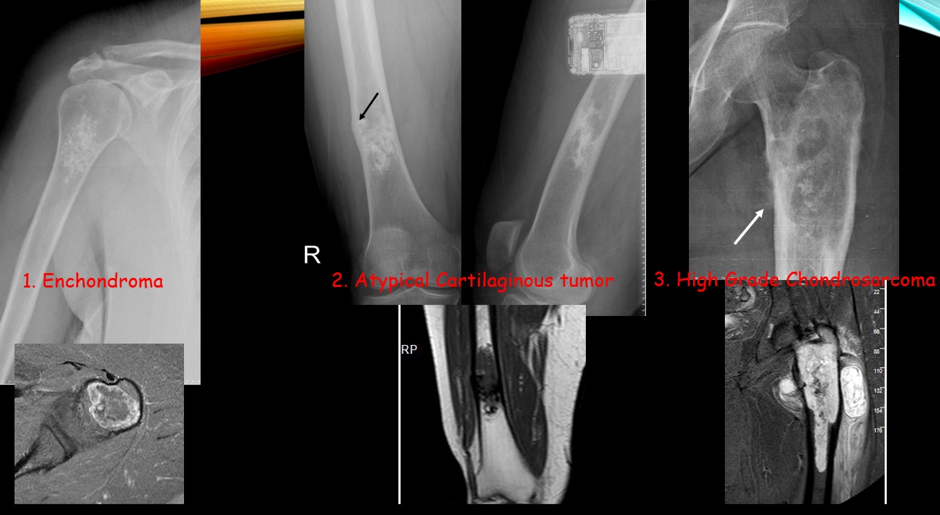 The utility of standing knee radiographs for detection of lipohemarthrosis: comparison with supine horizontal beam radiographs