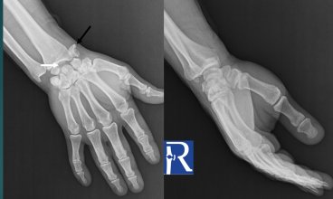 Displaced Scaphoid Fracture