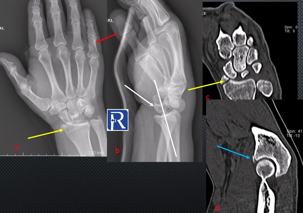 Chauffeur fracture with perilunate dislocation