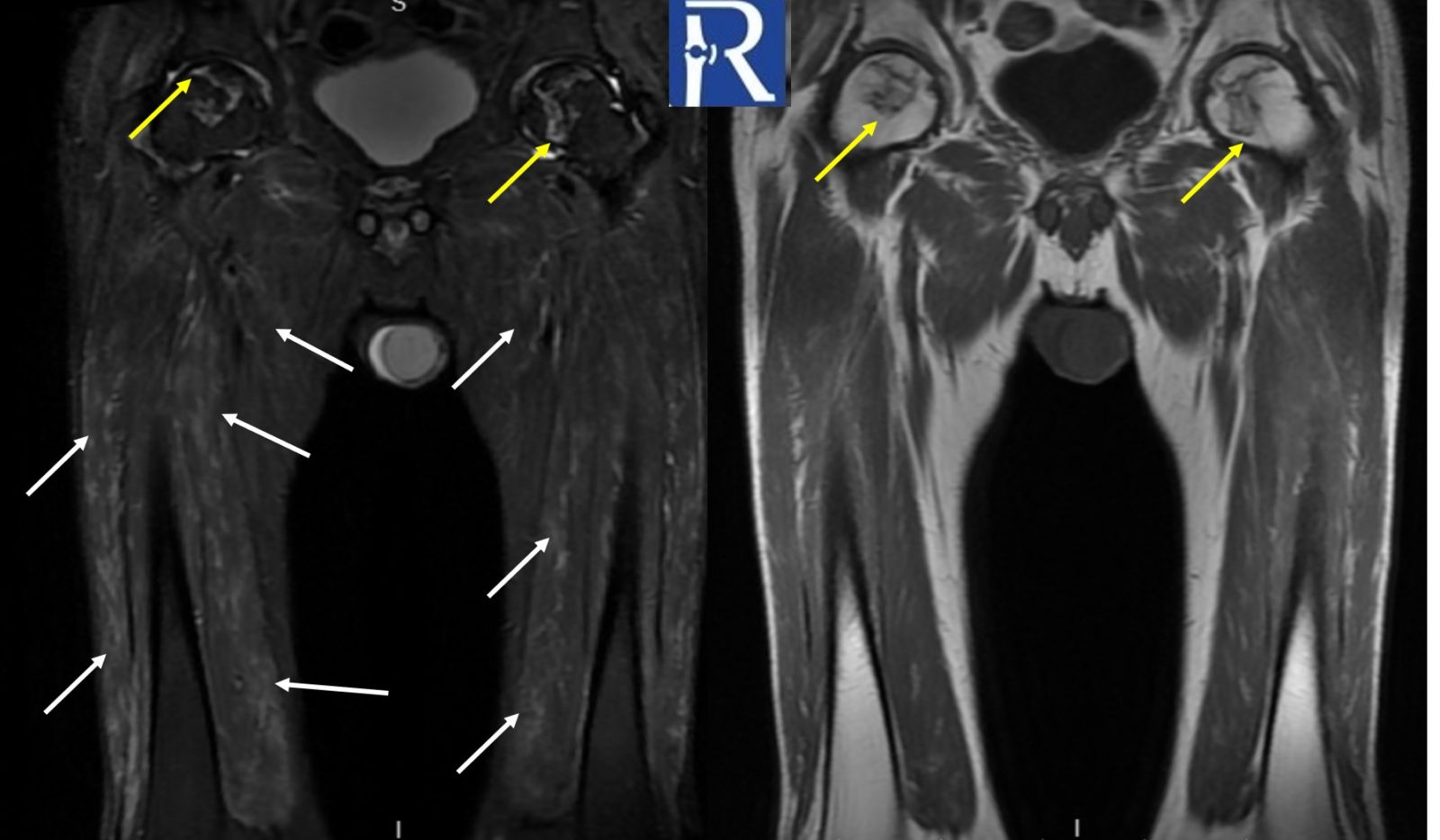 MRI of the both thigh reveals bilateral crescent-shaped, geographic lesions in the femoral heads consistent with osteonecrosis (formerly avascular necrosis) (yellow arrows). Additionally, there are bilateral, symmetrical, heterogeneous hyperintense signal changes—resembling edema—predominantly affecting the anterior muscle groups of the thighs (white arrows), indicative of myositis
